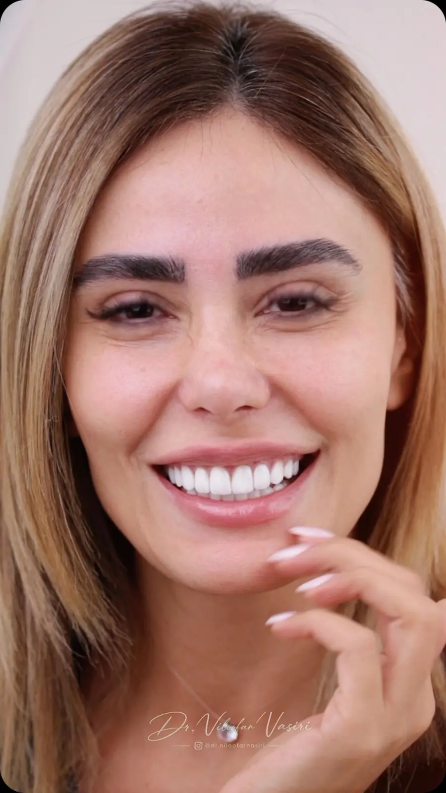 نمونه لبخند طراحی‌شده توسط دکتر نیلوفر نصیری