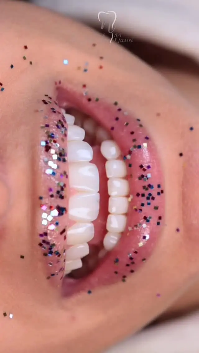 کامپوزیت ونیر طبیعی و نو کامپوزیت